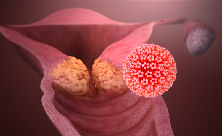 HPV'den Korunmak İçin Neler Yapılmalı? Nelere Dikkat Edilmeli?