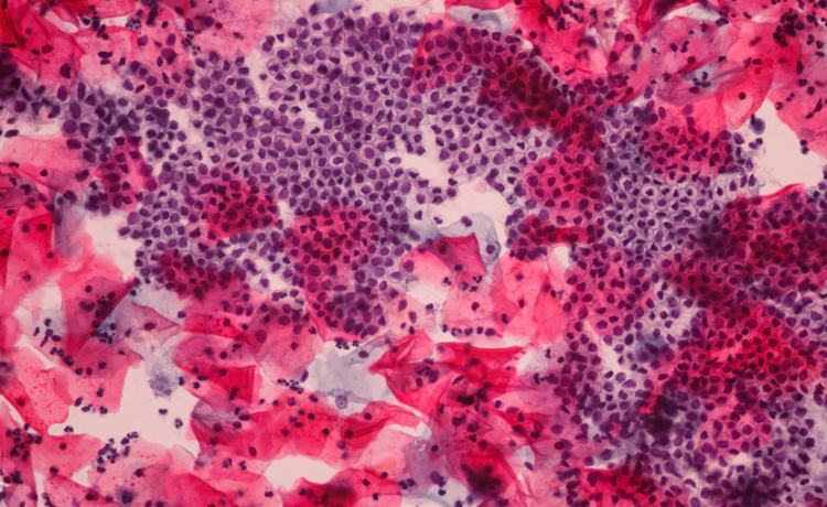 Genital Siğil Nedir?