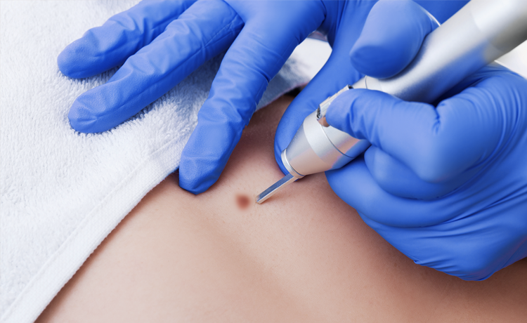 Genital Siğil Nasıl Geçer?