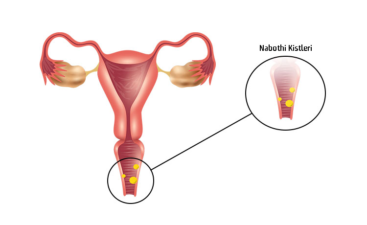 Nabothi Kistleri Kanseröz Olabilir mi?