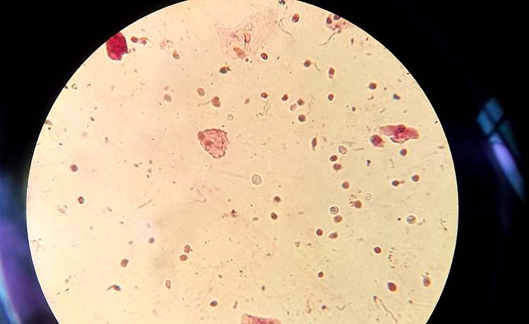 Trikomonas Enfeksiyonu Neden Oluşur?