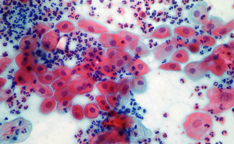 Smear Testinde Çıkan Anormal Sonuçlar Nelerdir?