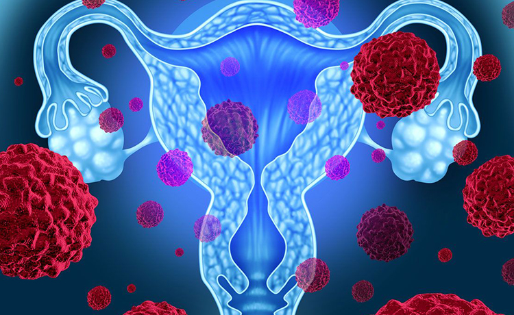 CIN (Servikal Intraepitelyal Neoplazi) Nedir?