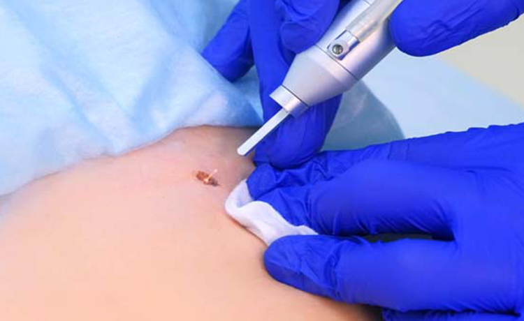 Hpv leep tedavisi - Hpv tedavisi ankara