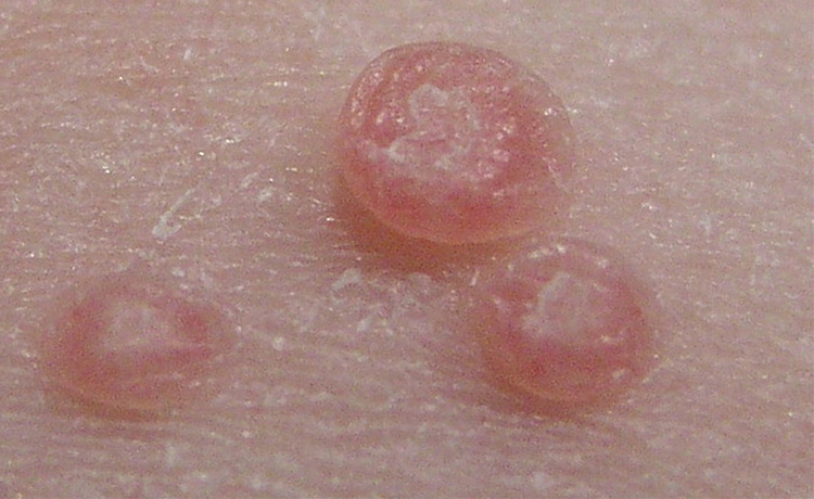 Molluskum Kontagiozum Belirtileri Nelerdir?