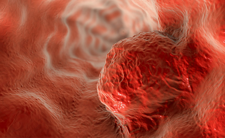 Özofagus Kanseri Nedir?