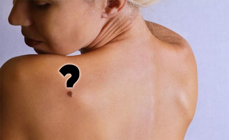 Cilt Kanserinin Belirtileri Nelerdir?