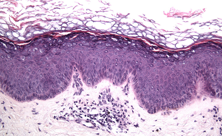 Cilt Kanserine HPV Sebep Olur mu?