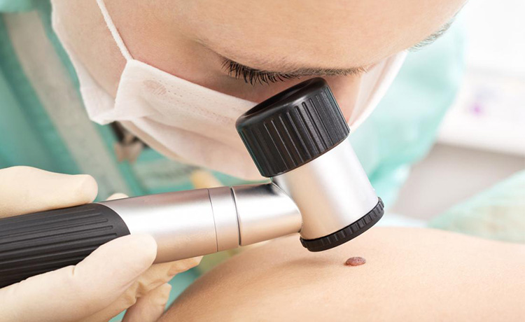 Cilt Kanseri Nasıl Teşhis Edilir?