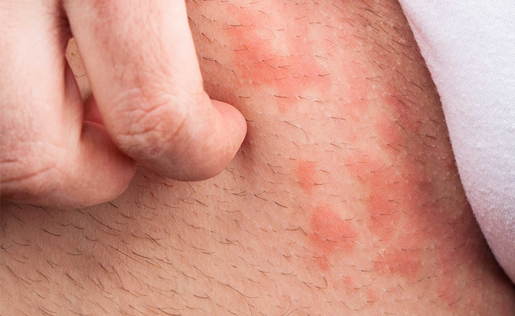 Kasık Bitinin Neden Olduğu Sorunlar Nelerdir?