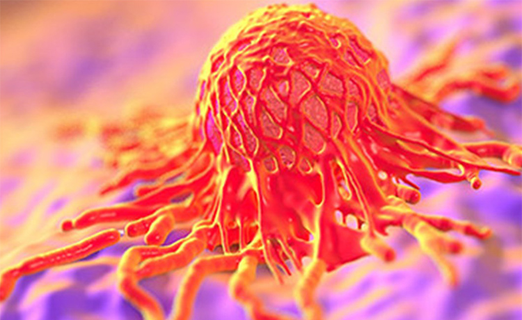 Yemek Borusu Kanserinde HPV Görülme Sıklığı Nedir?