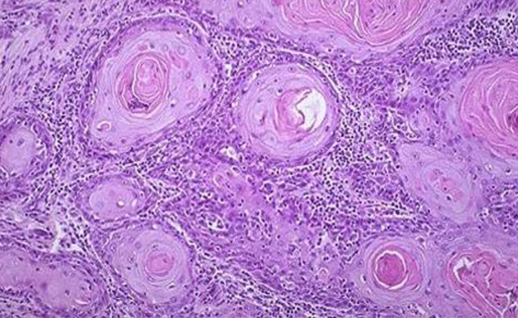 Penis Kanseri Ne Kadar Sürede İlerler?