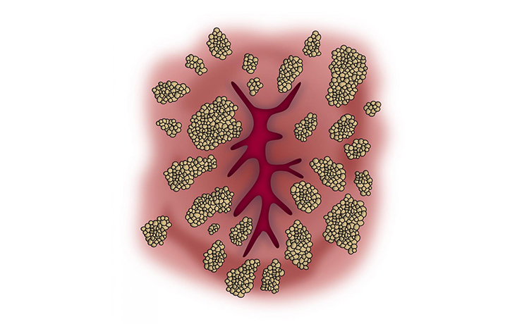 Kadın ve Erkekte Anal Kondilom