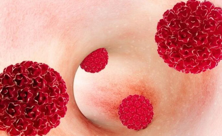 Kadın ve Erkekte Anal Siğilin Risk Faktörleri Nelerdir?