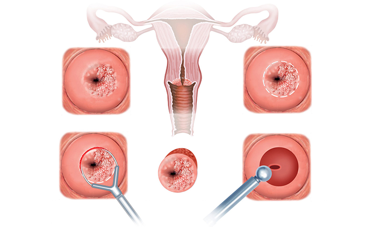 Konizasyon Leep Ne Demek?