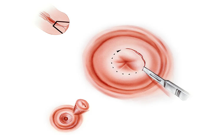 Soğuk Konizasyon Neden Yapılır?